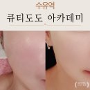 큐티피부관리실 | 수유역피부관리 받고 광채 미쳤던 날✨ 하이푸리프팅 + 스킨플래닝 받고 온 후기