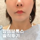 침샘보톡스 내돈내산 솔직 후기! 강남역 턱보톡스 효과 및 가격