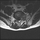 척추협착증(spinal stenosis)의 원인과 치료법 이미지