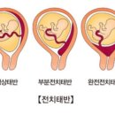 전치 앞(1) 이미지