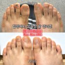 핀앤토 | 합정 핀앤토에서 문제성 발관리 받은 후기 무좀,내성발톱 추천