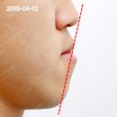 주걱턱 교정 후기, 모르면 손해인 부분