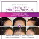 후헤어 - 시흥시 | 모발이식비용만 보고 결정하지 않았습니다｜이마축소 후 헤어라인 모발이식 후기