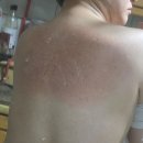 진메디칼솔루션 | 중구등드름 · 대봉동등드름 고민이라면? 솔에스테틱 대구점 바디리셋솔루션케어 [2회 패키지] 리얼 후기