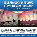 2080치과의원 - 북구 시랑로 75 | [경기광주 앞니충치] 앞니 사이 충치, 티 안 나게 레진으로 치료한 실제 후기