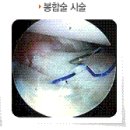 (무릎연골)무릎연골 손상되면 어떤 증상이 있을까? 이미지