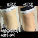 [대구 다이어트병원] 복부 지방분해주사 4회차 다이어트주사 가격 비만클리닉 후기