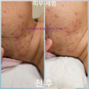 라라샵송정역점 | [라라샵 송정역점] 피부체험 후기 (전후사진) /라라소닉 문제성피부 여드름피부개선