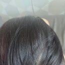 늘푸른의원 | 40-50대 여성 탈모치료 대전늘푸른의원 방문 3개월 후 후기 부작용, 효과