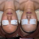 마산합포구 ⓗ-14 | 창원/마산 화농성 좁쌀 여드름 피부관리 1~14주 후기!!(+AC 문제성 피부관리)