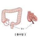 충수암(appendiceal carcinoma)| 이미지