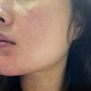 이현재피부과의원 | [부산 서면 - 이현재피부과]모낭염, 주사피부염, 안면홍조 첫 방문 상담&amp;치료 내돈내산 후기!