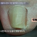 홀드핀칭 이미지