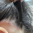 휴약국 | 청소년 건선 증상, 연고만으론 부족했던 우리 아이의 관리법