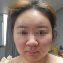 수인약국 | 서면이중턱 지방흡입(붓기, 흉터, 다이어트)12주 리얼 변화 후기