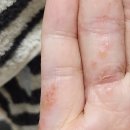큰경북약국 | 한포진, 손 무좀, 성인 아토피 치료 후기 | 내돈내산 연고 추천 | 가려움 관리 방법