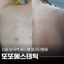 또또에스테틱1004 | 등드름 고민 해결하기_신림피부관리 또또에스테틱1004 알라딘필링 받아본 후기