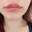 리노보의원 | [부산 서면] 입술 필러 후기