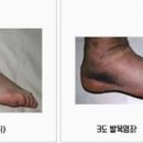 발목 통증 인대 늘어났을때 효능 및 증상 파열 이미지