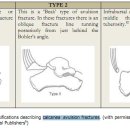 calcaneal avulsion fracture test -＞ Hoffa&#39;s test 이미지