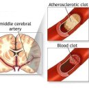 ※ 뇌졸중 전조증상 과 예방법※ 이미지