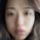 전북 전주 사랑니 잘 뽑는 곳 추천/ 정말... 지옷같았던... 오른쪽 매복 사랑니 2개 발치 후기 😭