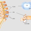 추간판탈출증장해,추간판탈출증장해진단,추간판탈출증,추간판탈출증원인,추간판탈출증증상,추간판탈출증치료,추간판탈출증수술,추간판탈출증합의 이미지