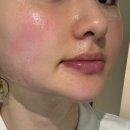 전주아름다운피부과의원 | [논현역피부과] 더아름다운의원에서 온다 리프팅 체험, 볼 라인 관리받아본 후기