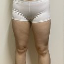 멍발머리 | [공지] 대구 허벅지지방흡입 후기 붓기 멍