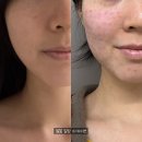 네이루 | 결혼 전 신부관리 강남역 성형외과 리쥬란4cc 수면 통증 엠보 2일차 후기