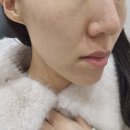 예쁨주의 | 창원 피부과, 예쁨주의 쁨의원 쥬베룩볼륨 2차 후기