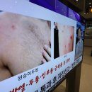 ▲"성병처럼 토착화 우려"…'엠폭스' 얼마나 퍼졌길래 [이지현 기자의 생생헬스] 이미지