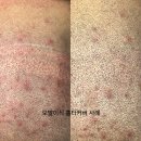 인천 두피문신: 자연스러운 헤어라인을 위한 완벽한 선택