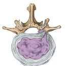 4-5번 허리디스크 (요추 추간판 탈출) 투병읽기 이미지