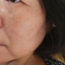 티나성형외과의원 | 내돈내산!!) 어머니의 상안검+리프팅 효도후기💗10년이... 젊어지셨다니👍👍