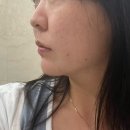 삼성의원 | 삼성역피부과 ㅇㅇ의원 쥬베룩 볼륨 + 티타늄 리프팅 후기💉