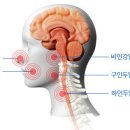 ◇ '하인두암'의 증상과 치료 방법 ◇ 이미지