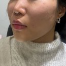 강남-274 | 강남역 피부과 티타늄 리프팅 쥬베룩 볼륨 시술 후기 팔자 개선 효과