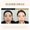 에미뜨의원 | 수원피부과 온다리프팅? 에미뜨의원 대표원장이 받아봤습니다