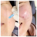 에이치비(HB)메디칼 | 해결 피부시술 손주사 리쥬란 힐러 마취 / 통증 / 후기(ft.MTS 스킨부스터 vs. 샤넬주사 vs. 리쥬란 비교)