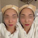 남피부과의원 | 성수역 근처 피부과의원 브이로어드밴스 내돈내산 강추 후기