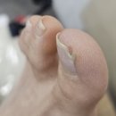 (주)청담 | 강남 아크릴페디 깨진 엄지발톱 이쁘게 되살려준 주네일 청담점