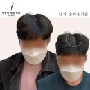 마음에점을찍다두피SMP 이미지