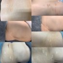 천안탈모튼살스킨커버아카데미 이미지