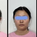 서울한방병원 | 서울 한방병원 비대칭 턱교정 후기 (내돈내산, 강력 추천)