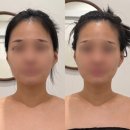 채움 | 아산 피부관리 살롱드코지 윤곽관리 채움술 후기