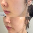 사상 | 부산 쥬베룩 스킨 사상 피부과 내돈내산 후기 통증 효과