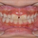 아름다운e치과교정과치과의원 | [병원 후기]초딩 딸 매복치 교정 과정 1 (feat.아름다운e치과교정과치과의원)