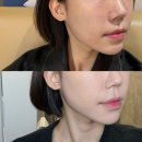 포르테의원 | 논현역 피부과 민트실 포르테더블 실리프팅 일주일 후기