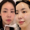 삼성동피부과 큐티셀 블랙라벨 스킨부스터 연예인 피부관리 추천 후기